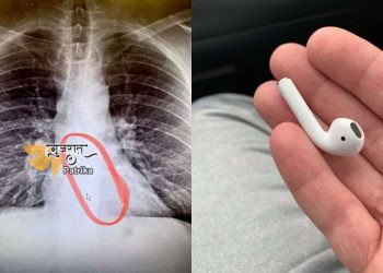 इस व्यक्ति ने अपनी नींद में एप्पल के एयरपॉड्स को निगल लिया, सीने में दर्द एक्स-रे गिरने के लिए जाना जाता है !